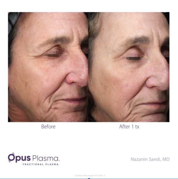 opus plasma before and after