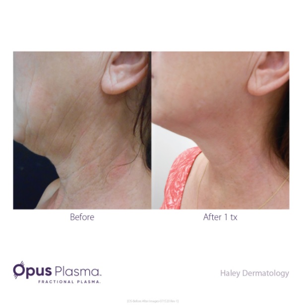 opus plasma before and after3