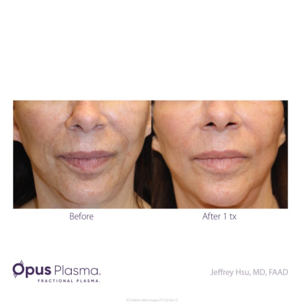 opus plasma before and after4