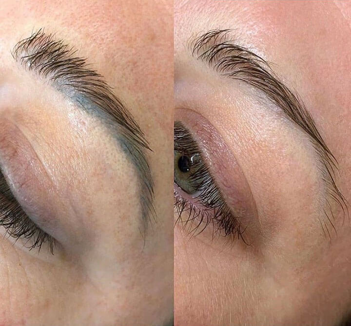 Everything You Need To Know About Eyebrow Tattoo Removal