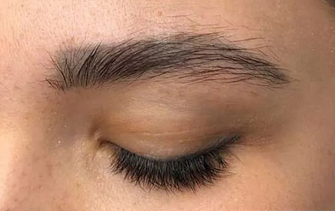 Permanent Makeup Eyebrow Tattoo Removal - Laser Remedy Skin Solutions